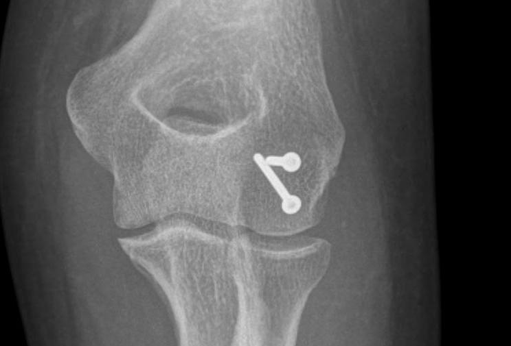 Capitellar Fracture ORIF0001